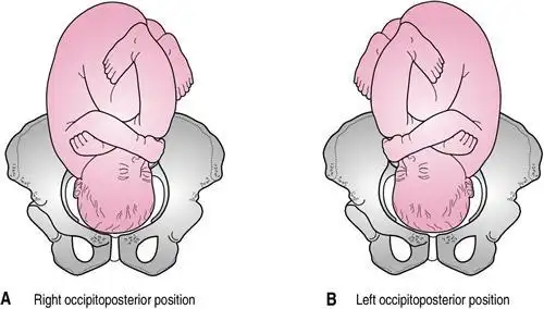 持续性枕后位难产