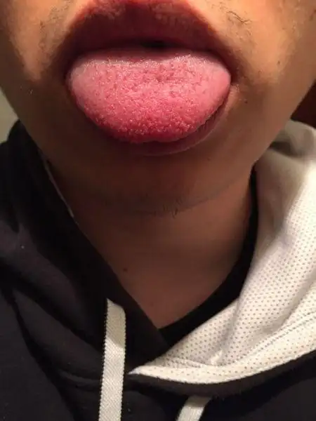 舌头出现好多小泡,还有些裂纹,感觉发麻,老是感觉口渴.