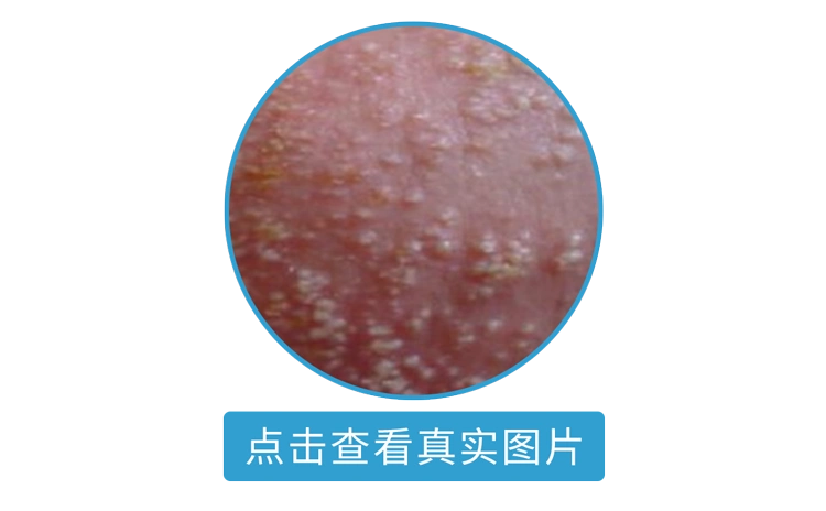 小心「炸蛋」|阴囊湿疹|瘙痒|性病|皮疹|皮肤|-健康界