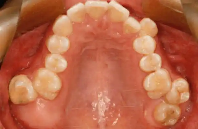 或者是这种上下牙槽骨都突出来 (也叫双牙弓前突).