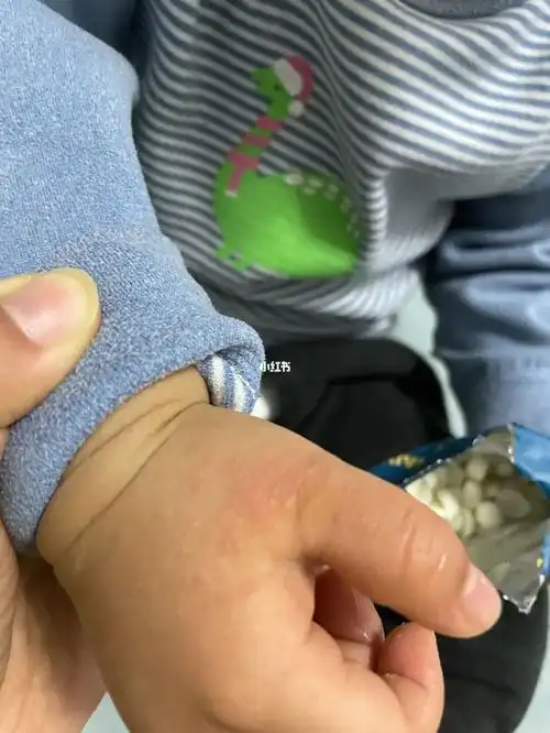 摩擦性苔藓又称沙土性皮炎