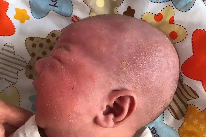 过敏性皮炎图片