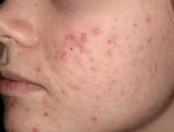 急性胃扩张病人可发生_乙肝和艾滋那个病可怕_艾滋病急性期