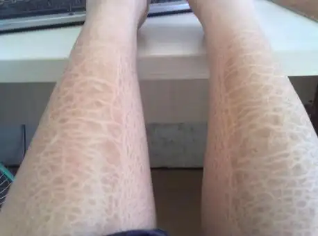 皮肤涂什么药,用这个家里护肤品都可以丢了 鱼鳞病,中医也叫蛇皮癣