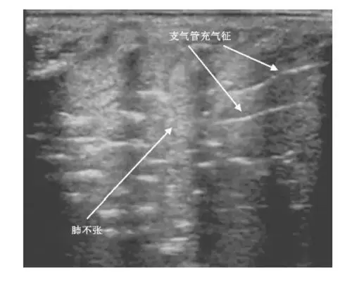 肺的超声影像呈肝样变,可伴有支气管充气征或支气管充液征