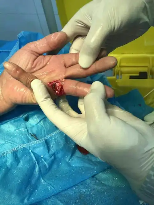 一例手部皮肤撕裂(撕脱)伤处理流程