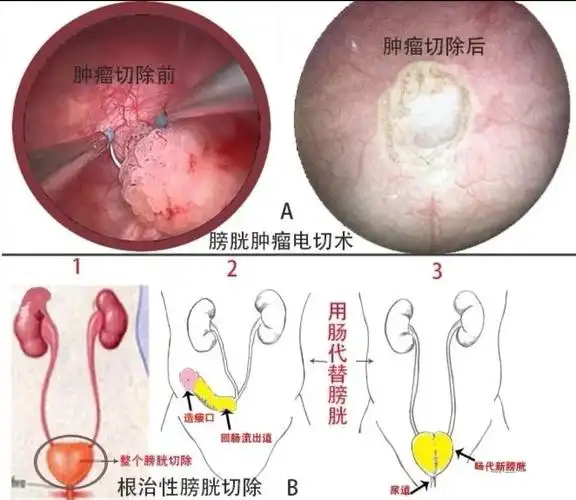 膀胱癌如何治疗?