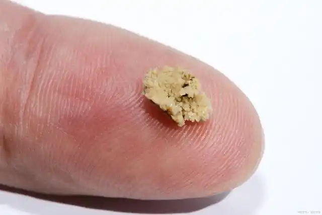 肾结石病人可以吃蛋白粉吗