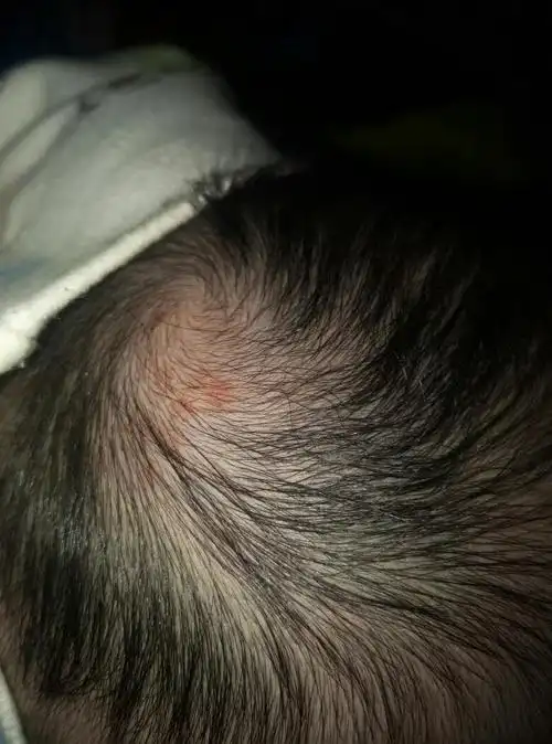 宝宝头皮上有指甲盖大小的血管瘤 谁能帮忙支招