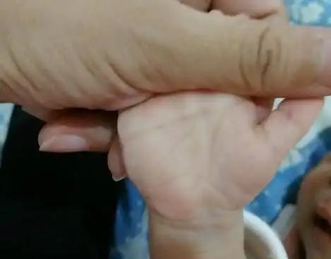宝宝双手断掌爱咬手指, 但孕期无创低风险过! 凭什么说是唐氏儿!