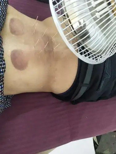 发展中医理疗,积极推广中医适宜技术迷坝乡卫生院这样做