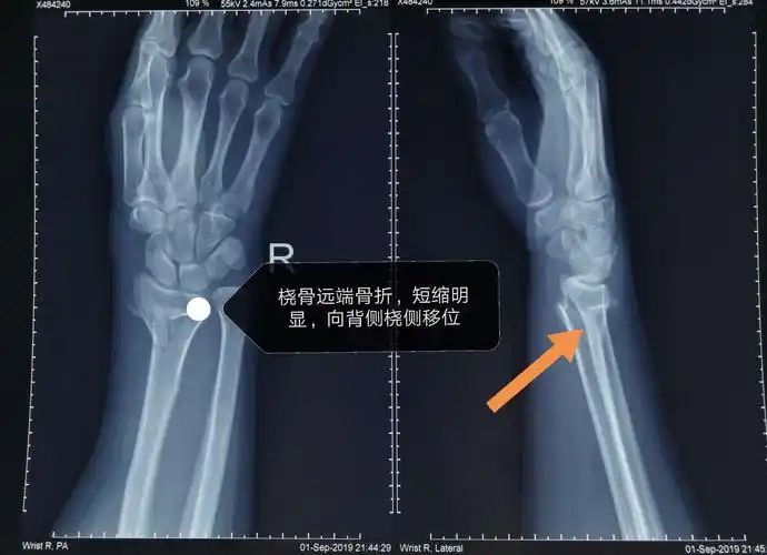 典型的colles骨折