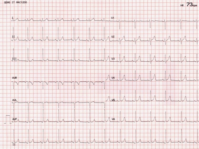 所有典型心电图全有哦,还是临床常用的 1,窦性心律;大致正常心电图