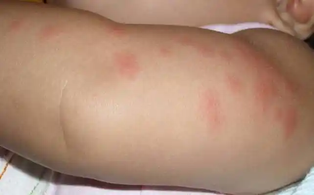 换季皮肤过敏怎么缓解