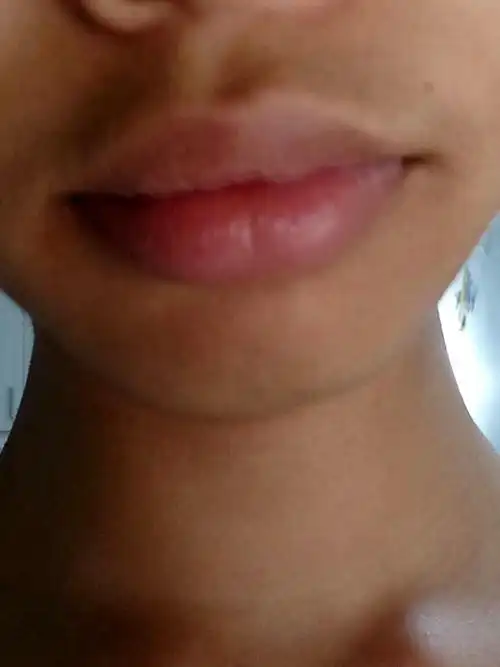 嘴唇太厚怎么办什么药最好?