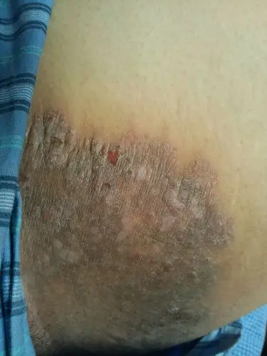 前2个月可能内裤买小了,导致大腿内侧有点勒的发痒,越痒越挠,现在成