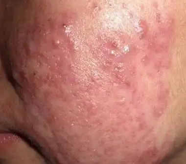 丘疹性痤疮【多图】_39医疗图集-39健康网