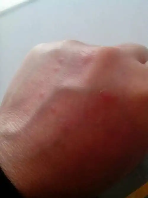 手上起了红疙瘩是怎么回事