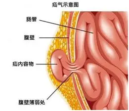 【友活动】早春时节,好谋疝断——"中国疝气日"义诊正在进行中_腹股沟