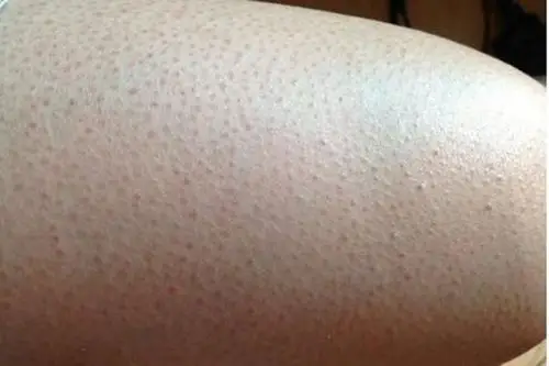 毛周角化症图片39