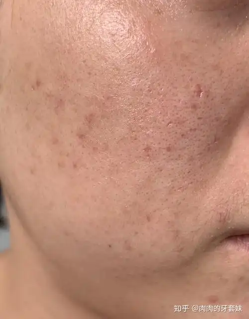 痘坑持续抗战微针