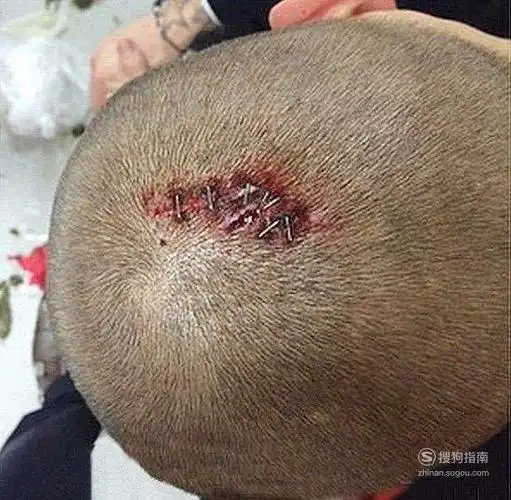 头部缝针后哪些食物不能吃