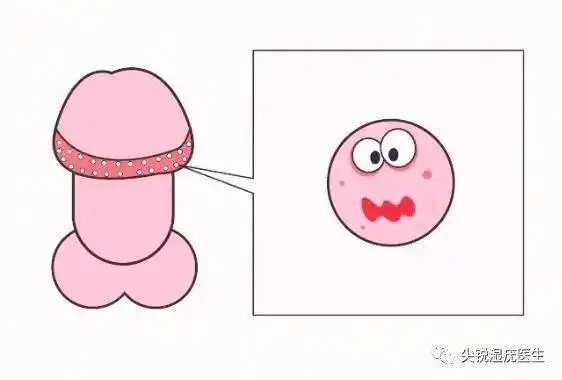 冠状沟长了一圈小米粒_珍珠_男性_情况