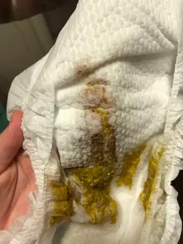 宝宝便便出现褐色