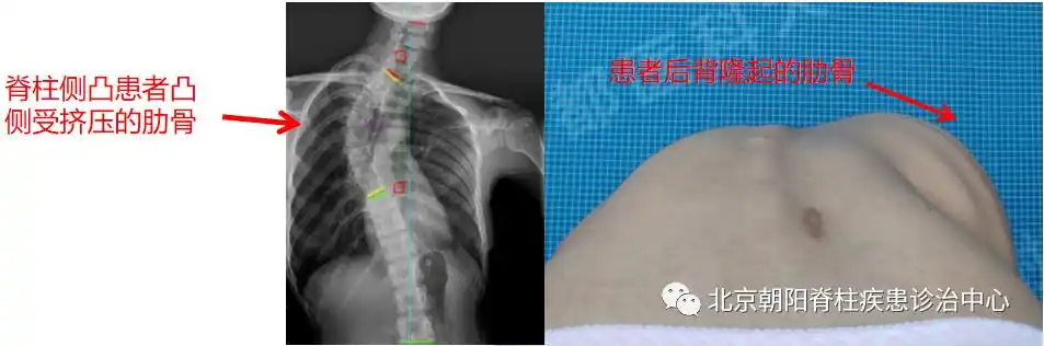 脊柱侧凸唤醒月 | 后背的鼓包是怎么回事?