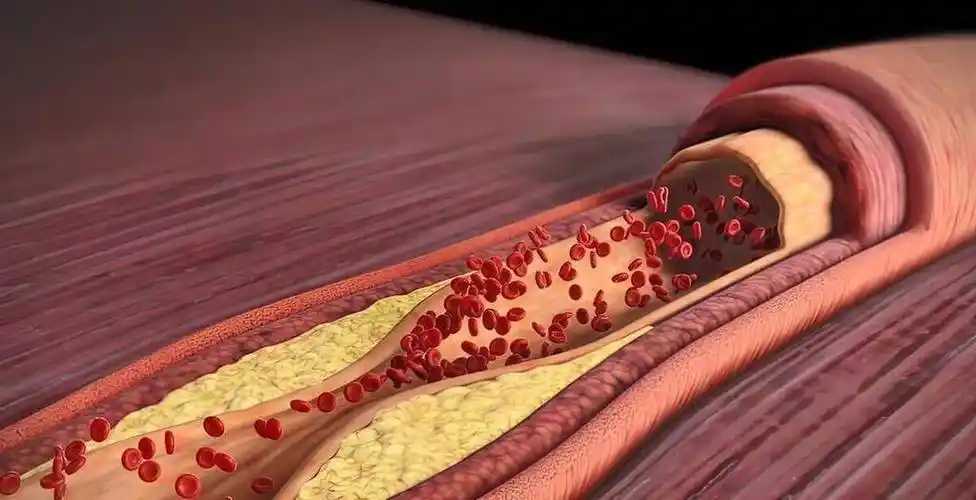 冠心病的本质是血液淤堵了,不懂净血液,疏血管,吃多少药都白搭_问题