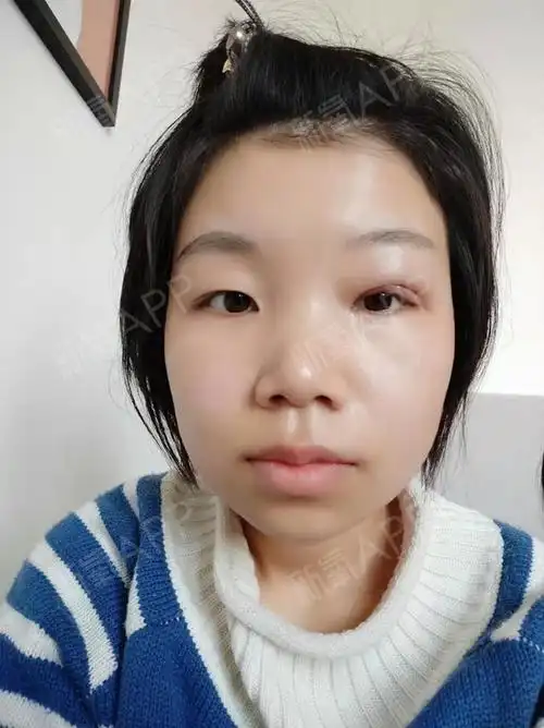 眼睛一大一小的特别不均衡,后来才知道是叫上睑下垂,_圈子-新氧美容