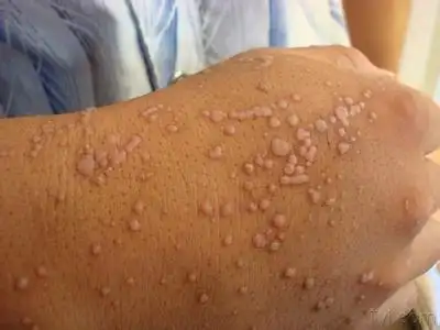 hpv感染能怀孕吗 hpv感染后会引起哪些典型症状