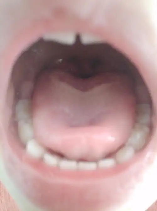 上医院查询过一次,说是地图舌,正常不影