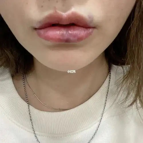 娇兰玻尿酸纹唇