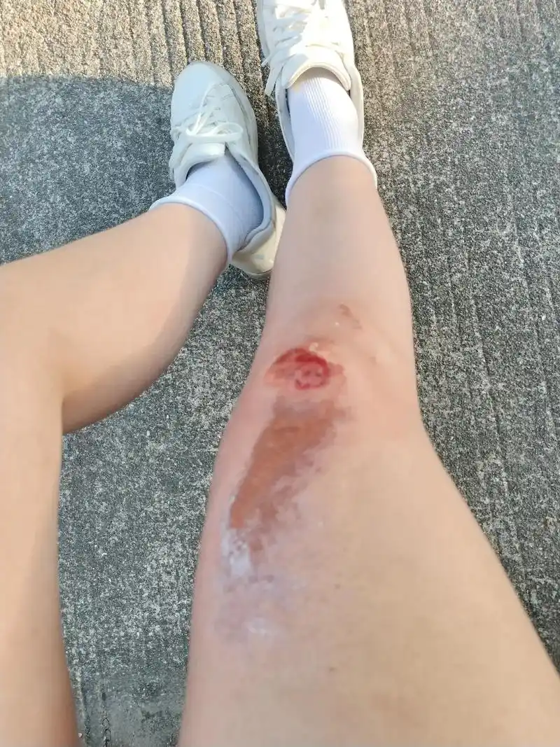 一不小心摔伤了腿,才知道什么叫"举步维艰".成年人的世界里没 - 抖音