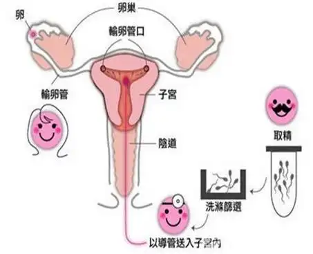 人工受孕多少钱:人工受孕费用一般多少 人工受孕方法