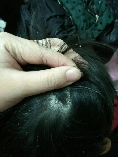 四岁宝宝有头皮屑,换了洗发水也没用