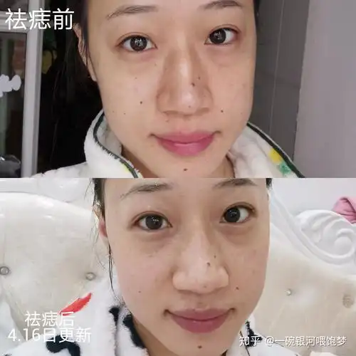 激光电烧祛痣点痣记录