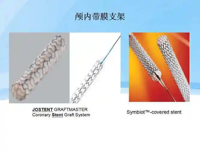 不同类型颅内支架在脑动脉瘤治疗中的应用