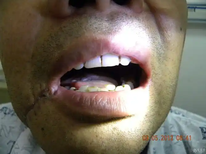 全舌切除后"全舌再造术"