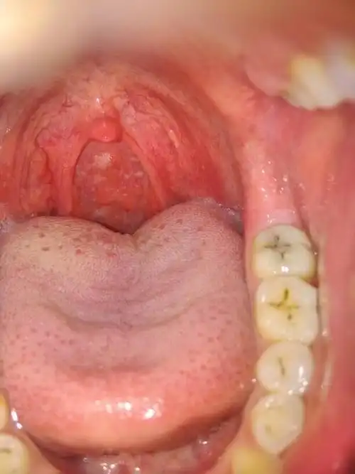 有时候痰多吐完觉得咽喉那里干燥. 还有经常早