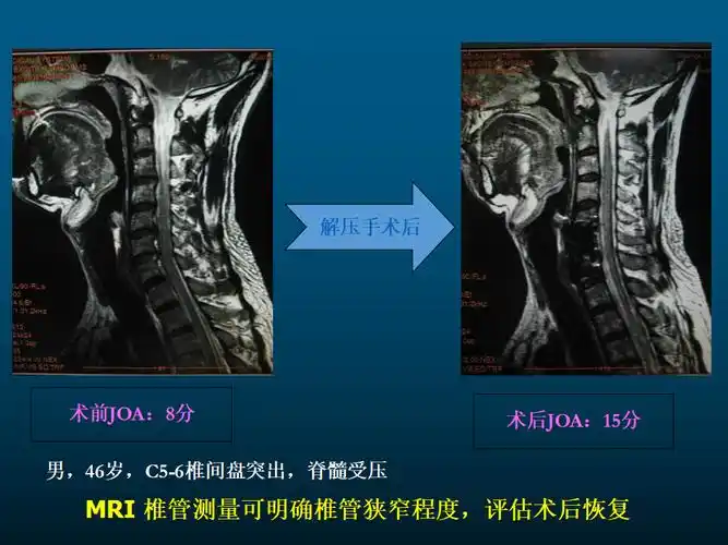 一篇课件详解颈椎病的mri诊断技巧