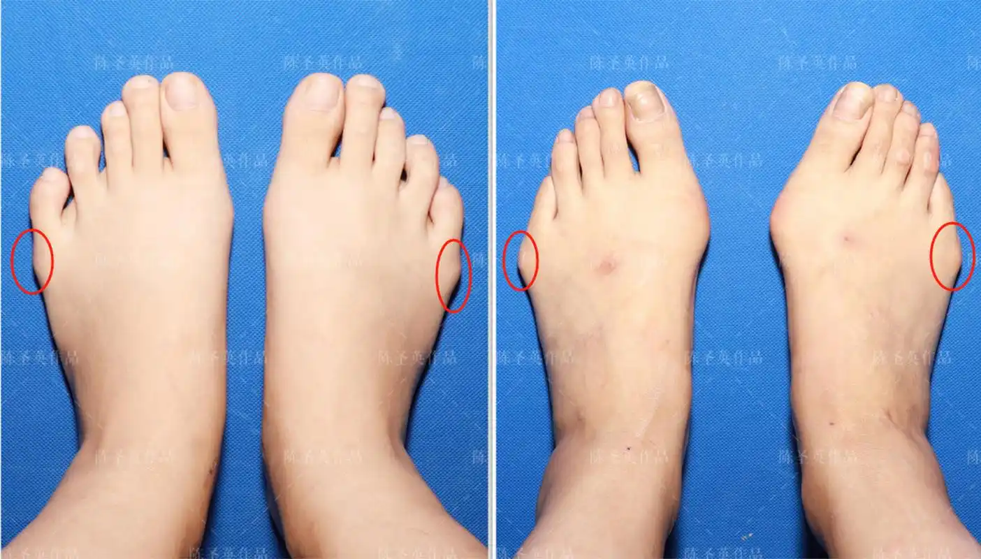 小脚骨会导致足部外观缺陷,局部红肿发炎,甚至破溃,感染.