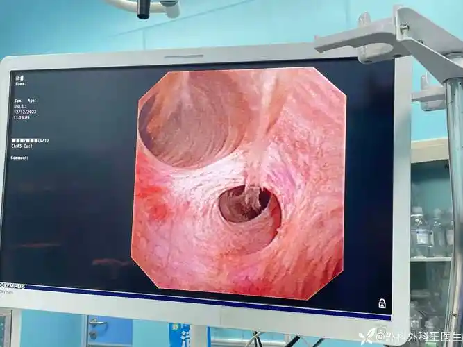 既往开腹切胆囊后胆总管结石腔镜下手术