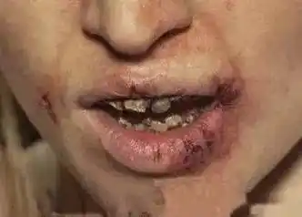 会带来严重面部皮肤问题, 如重度痤疮,溃烂等 会导致牙齿变