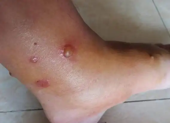 健康红河 | 预防春季多发病别大意_腾讯新闻