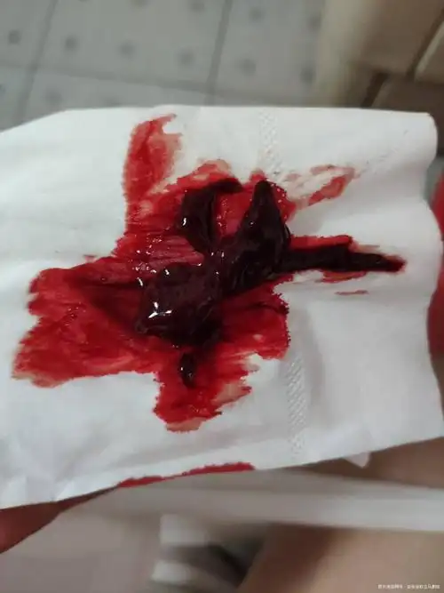 顺产第八天恶露量大如月经内有血的图片