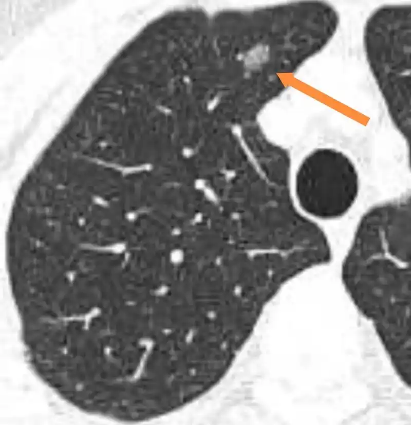 查体发现,病理结果为肺原位癌.手术后不需要化疗 - 抖音