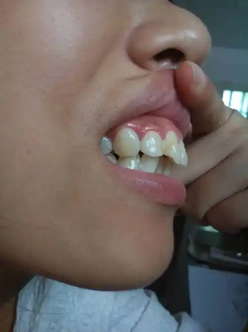 这是骨性龅牙吗?怎么矫正,大约花多少钱?