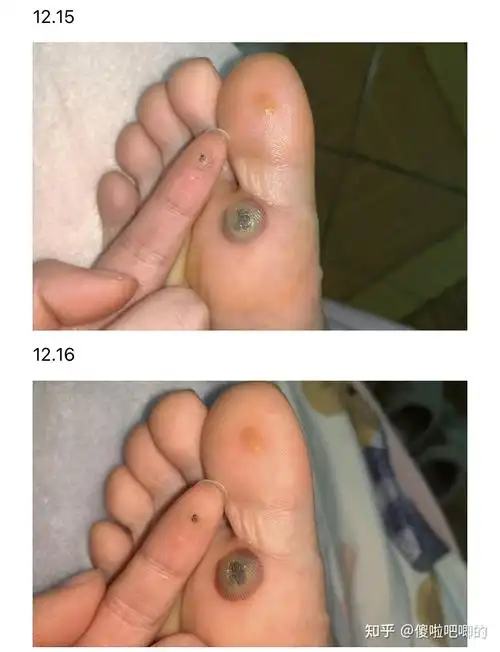 液氮冷冻跖疣记录 - 知乎
